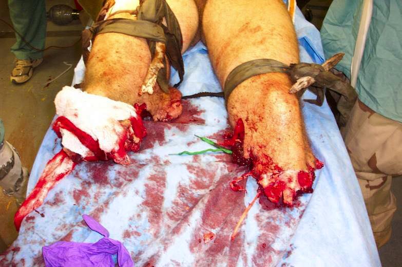 Garrots improvisés sur double amputation traumatique