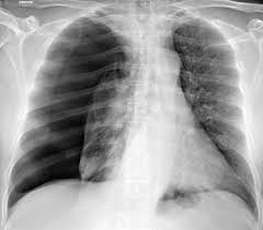 Pneumothorax sous tension, radiographie du thorax